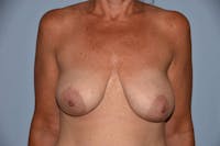 Breast Reconstruction Before & After Gallery - Patient 687227 - Image 1