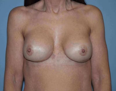 Breast Revision Before & After Gallery - Patient 142399 - Image 2