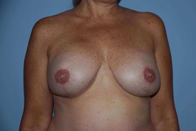 Breast Reconstruction Before & After Gallery - Patient 687227 - Image 2