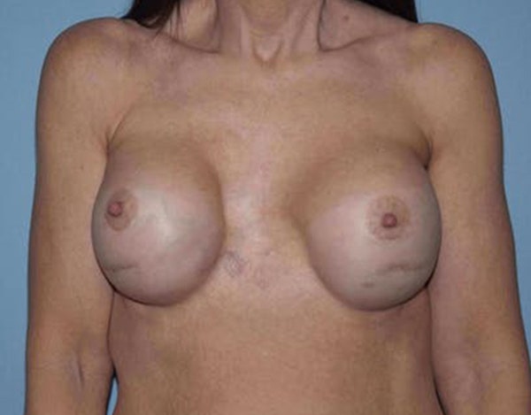 Breast Revision Before & After Gallery - Patient 142399 - Image 3