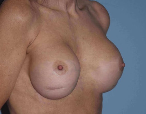 Breast Revision Before & After Gallery - Patient 142399 - Image 5