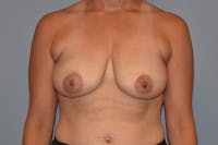 Breast Reduction Before & After Gallery - Patient 255783 - Image 1