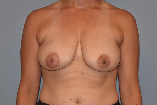 Breast Reduction Before & After Gallery - Patient 255783 - Image 1