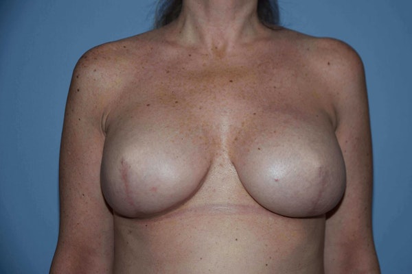 Breast Reconstruction Before & After Gallery - Patient 687227 - Image 9