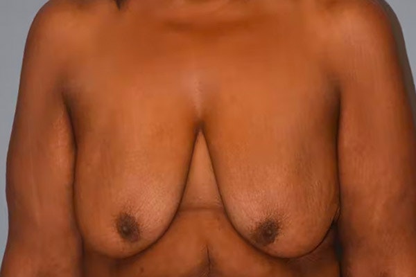 Breast Lift Before & After Gallery - Patient 477186 - Image 1