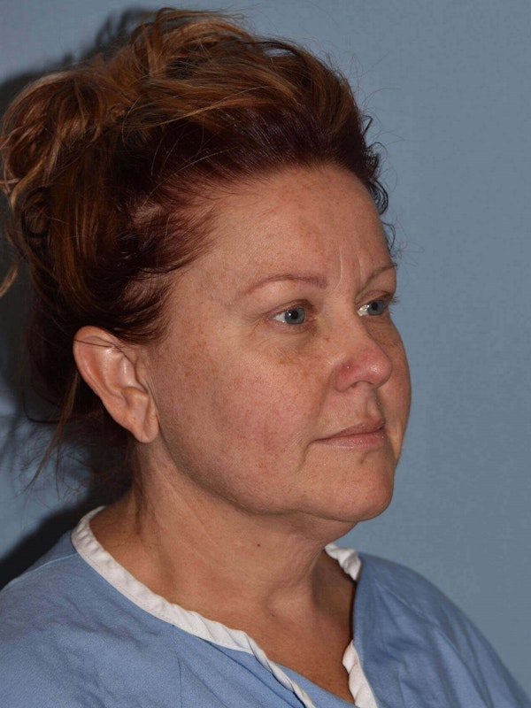 Facelift Before & After Gallery - Patient 124109 - Image 3