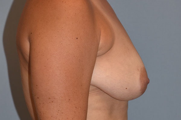 Breast Reduction Before & After Gallery - Patient 255783 - Image 7
