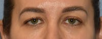 Eyelid Lift Before & After Gallery - Patient 257301 - Image 1