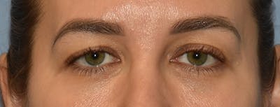 Eyelid Lift Before & After Gallery - Patient 257301 - Image 1
