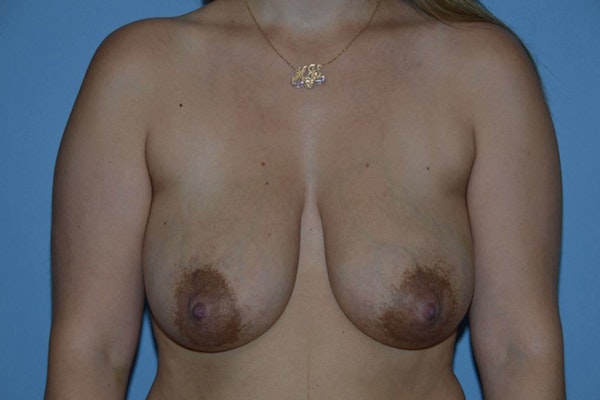 Breast Reconstruction Before & After Gallery - Patient 141508 - Image 1