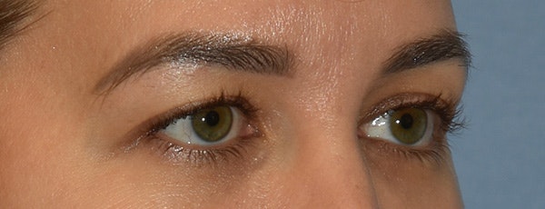 Eyelid Lift Before & After Gallery - Patient 257301 - Image 3