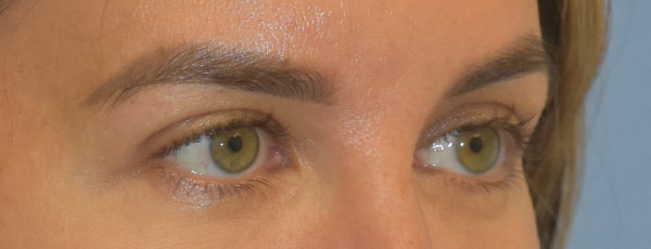 Eyelid Lift Before & After Gallery - Patient 257301 - Image 4