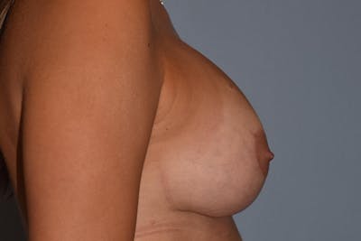 Breast Augmentation Lift Before & After Gallery - Patient 418079 - Image 6
