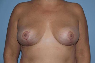 Breast Reduction Before & After Gallery - Patient 127654 - Image 2