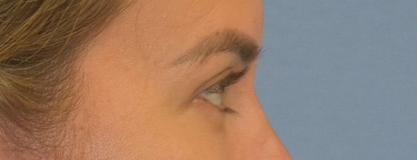 Eyelid Lift Before & After Gallery - Patient 257301 - Image 6