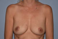 Breast Reconstruction Before & After Gallery - Patient 162115 - Image 1