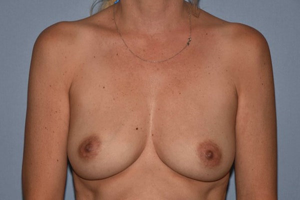 Breast Reconstruction Before & After Gallery - Patient 162115 - Image 1