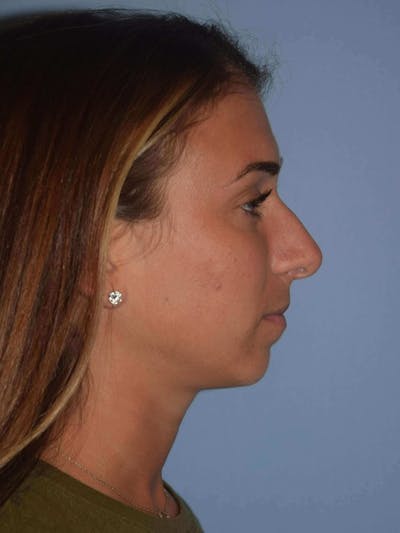 Rhinoplasty Before & After Gallery - Patient 320372 - Image 1