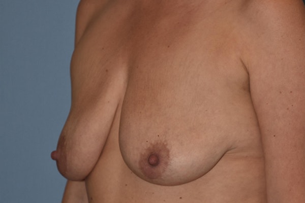 Breast Augmentation Lift Before & After Gallery - Patient 385898 - Image 3