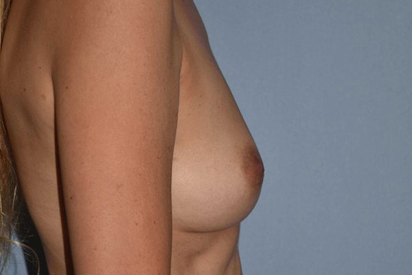 Breast Reconstruction Before & After Gallery - Patient 162115 - Image 5