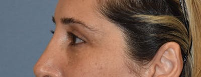 Eyelid Lift Before & After Gallery - Patient 353320 - Image 6