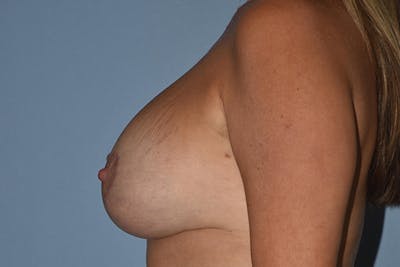 Breast Augmentation Lift Before & After Gallery - Patient 385898 - Image 6