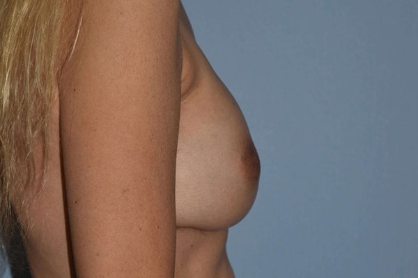 Breast Reconstruction Before & After Gallery - Patient 162115 - Image 6