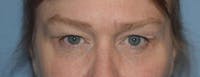 Eyelid Lift Before & After Gallery - Patient 255005 - Image 1