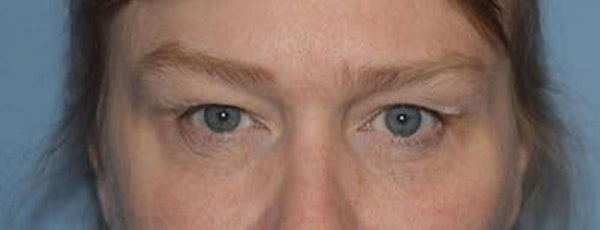 Eyelid Lift Before & After Gallery - Patient 255005 - Image 1