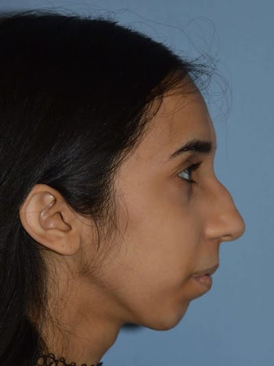 Rhinoplasty Before & After Gallery - Patient 348908 - Image 1