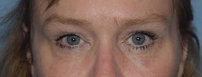 Eyelid Lift Before & After Gallery - Patient 255005 - Image 2