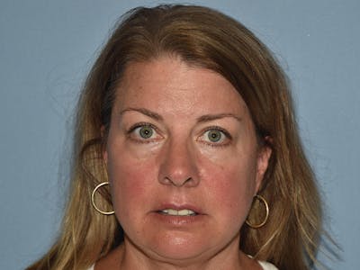 Facial Fat Grafting Before & After Gallery - Patient 217782 - Image 1