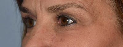 Eyelid Lift Before & After Gallery - Patient 405037 - Image 4