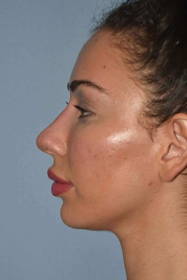 Nonsurgical Rhinoplasty Before & After Gallery - Patient 420876 - Image 2