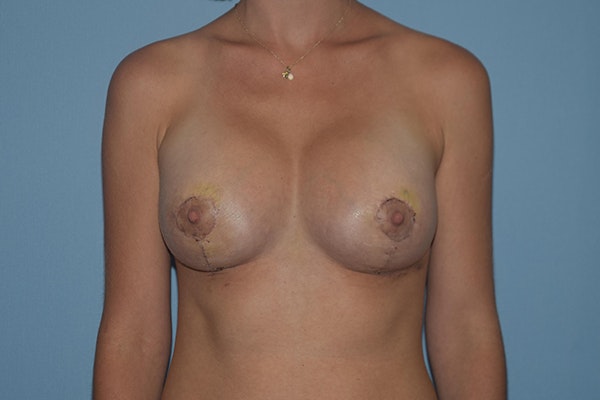 Breast Augmentation Lift Before & After Gallery - Patient 328443 - Image 2