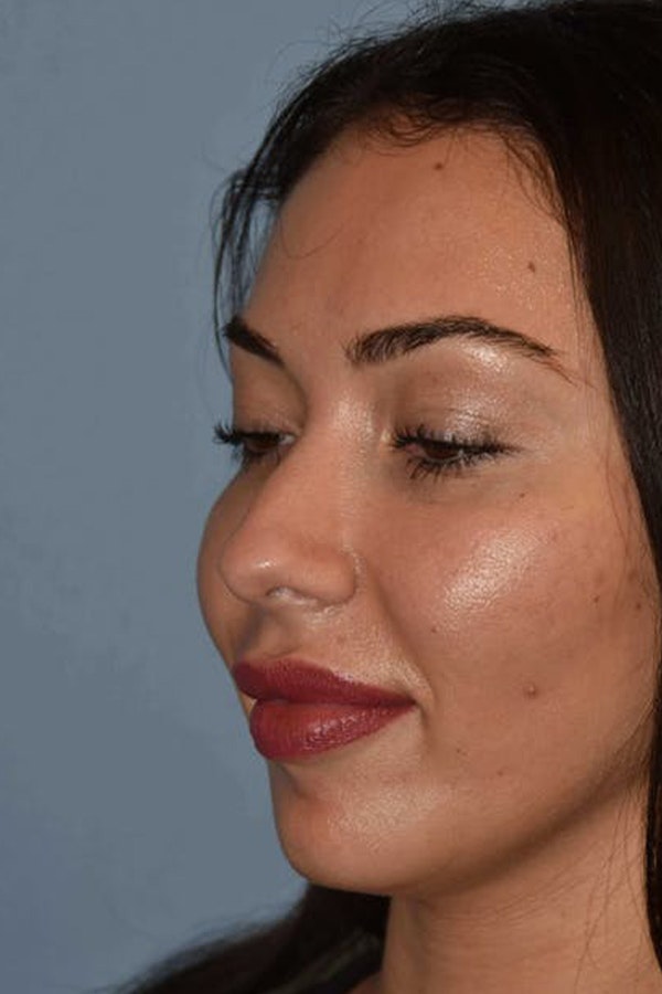 Nonsurgical Rhinoplasty Before & After Gallery - Patient 420876 - Image 3
