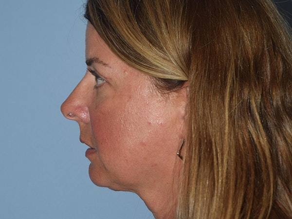 Facial Fat Grafting Before & After Gallery - Patient 217782 - Image 6