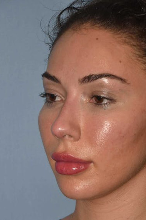 Nonsurgical Rhinoplasty Before & After Gallery - Patient 420876 - Image 4