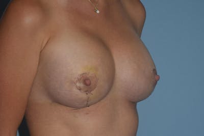 Breast Augmentation Lift Before & After Gallery - Patient 328443 - Image 4