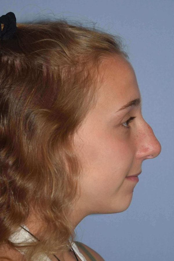 Nonsurgical Rhinoplasty Before & After Gallery - Patient 363271 - Image 1