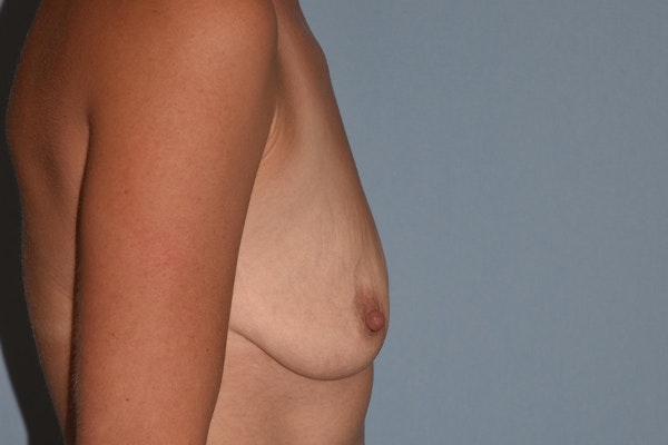 Breast Augmentation Lift Before & After Gallery - Patient 328443 - Image 5