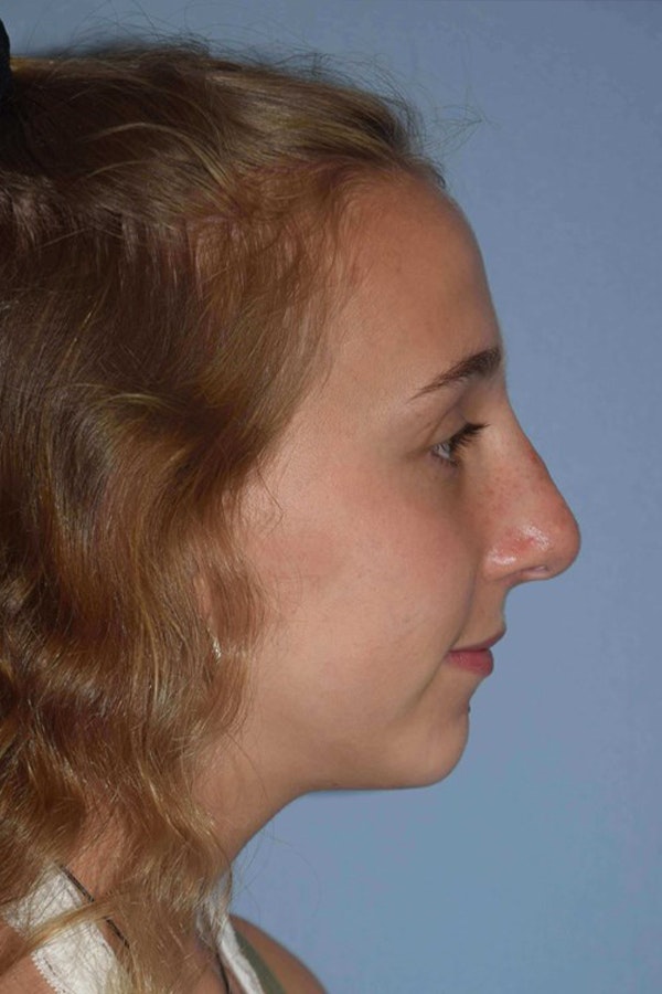 Nonsurgical Rhinoplasty Before & After Gallery - Patient 363271 - Image 2