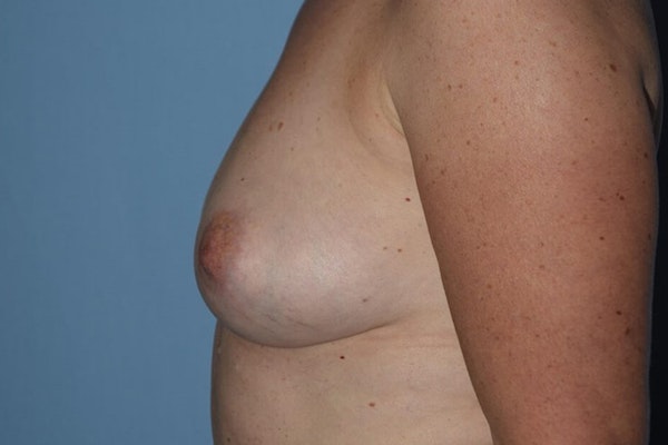 Breast Reconstruction Before & After Gallery - Patient 328946 - Image 5