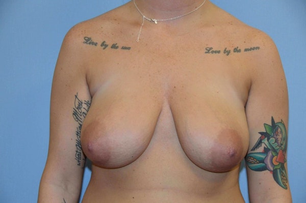 Breast Reduction Before & After Gallery - Patient 108426 - Image 1