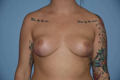 Breast Reduction Before & After Gallery - Patient 108426 - Image 2