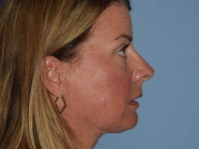 Facial Fat Grafting Before & After Gallery - Patient 217782 - Image 10