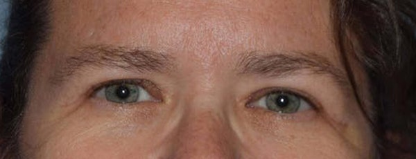Eyelid Lift Before & After Gallery - Patient 107915 - Image 2