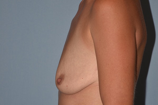 Breast Augmentation Lift Before & After Gallery - Patient 328443 - Image 9