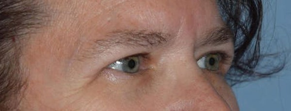 Eyelid Lift Before & After Gallery - Patient 107915 - Image 4