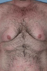 Gynecomastia Before & After Gallery - Patient 187816 - Image 1